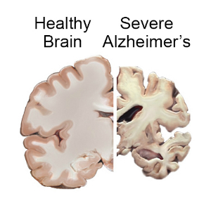 A Breath Away From a Cure: How Xenon Gas Could Transform Alzheimer’s Treatment